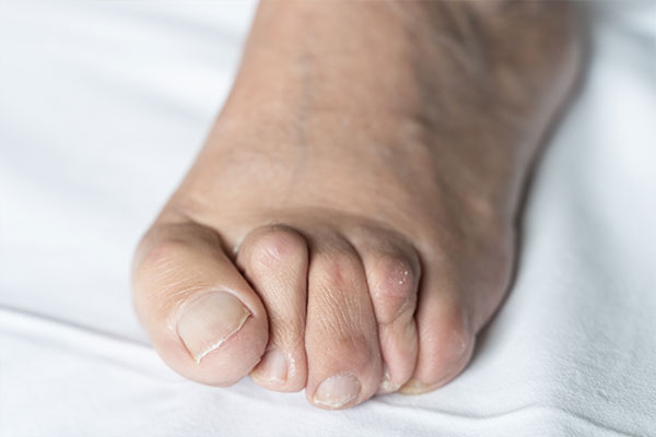 NY Foot   Ankle Specialists | Diabetic Foot Care, Hammertoes and Neuropathy